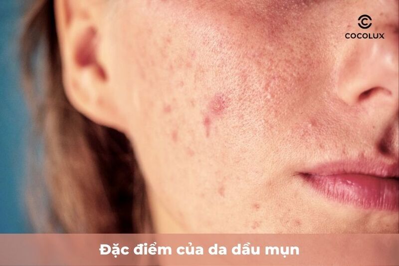 Đặc điểm của da dầu mụn