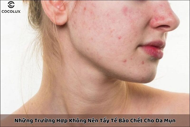 Trường hợp không nên tẩy tế bào chết cho da mụn