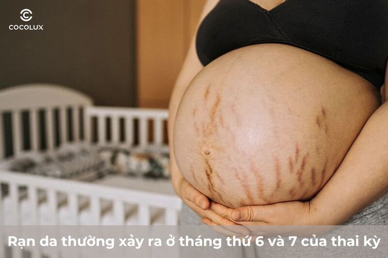 Rạn da khi mang thai xu&acirc;́t hi&ecirc;̣n khi nào?