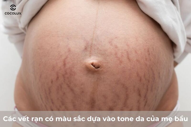 Các dấu hiệu rạn da khi mang thai