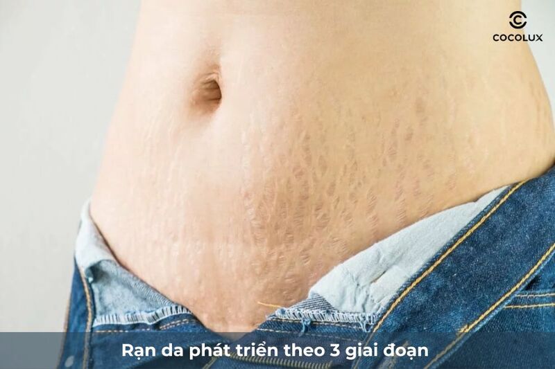 Rạn da tuổi dậy thì xuất hiện khi nào?