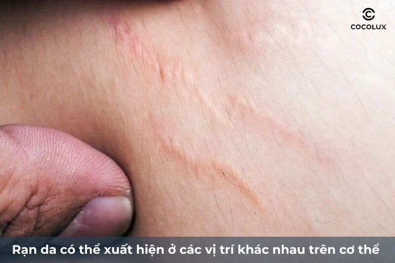 Vị trí xuất hiện rạn da tuổi dậy thì