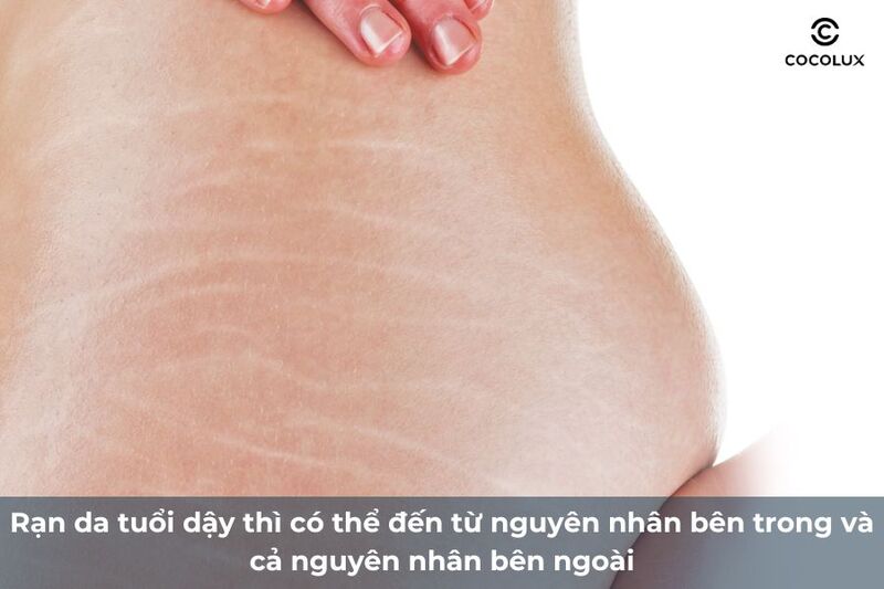 Nguyên nhân hình thành rạn da ở tuổi dậy thì