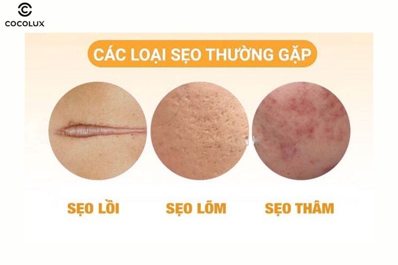 Các loại sẹo thường gặp