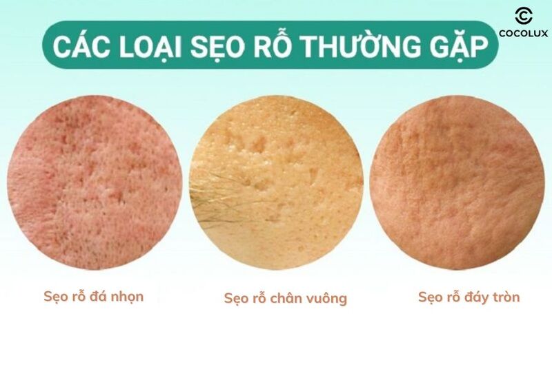 Phân biệt các loại sẹo rỗ theo hình dáng