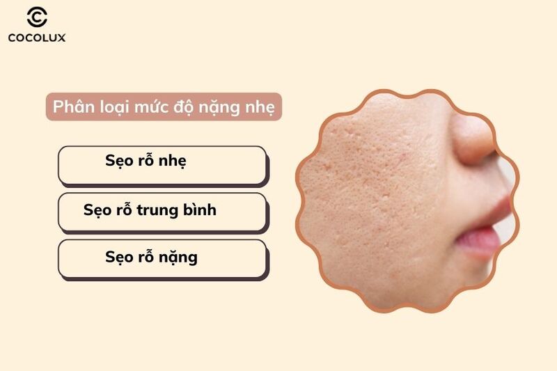 Phân loại sẹo rỗ theo mức độ nặng nhẹ 