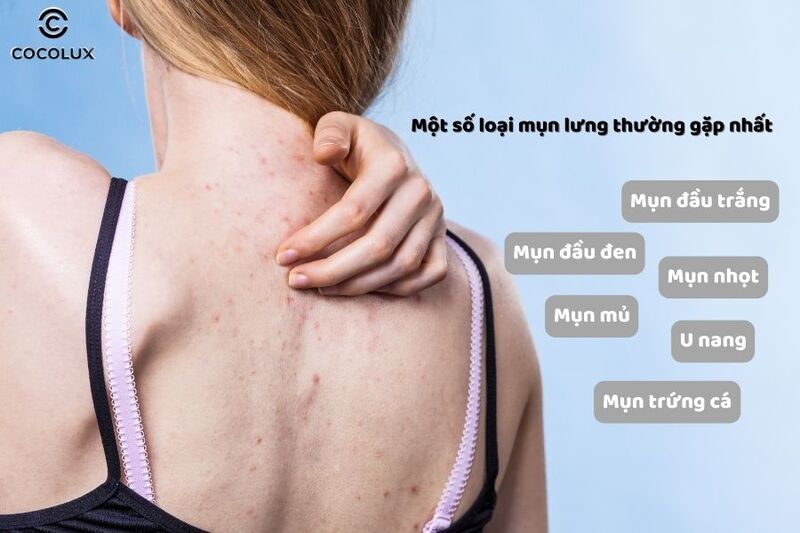 Một số loại mụn lưng thường gặp