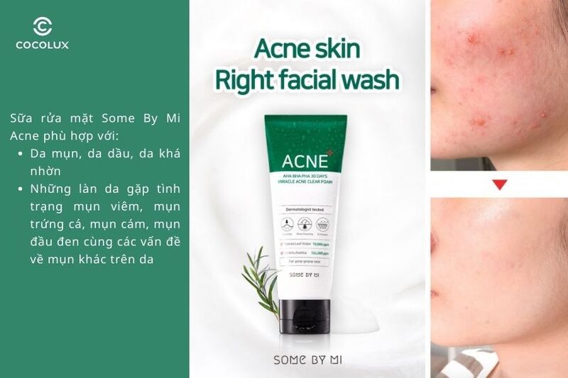 Sữa rửa mặt Some By Mi Acne phù hợp với những làn da mụn