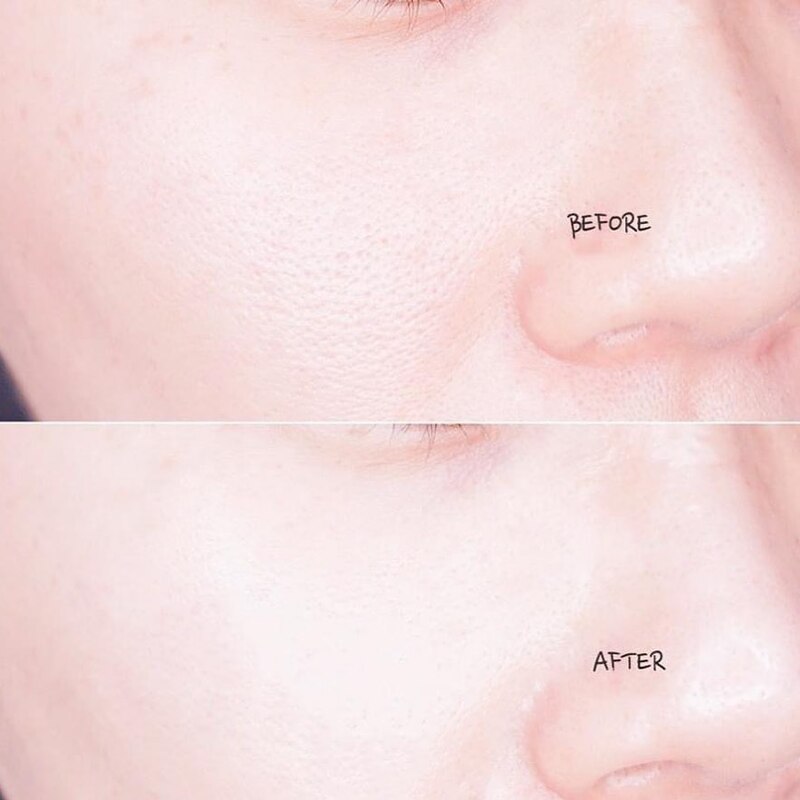 Serum So'Natural Red Peel Tingle Làm Giảm Mụn, Tái Tạo Làn Da 35ml
