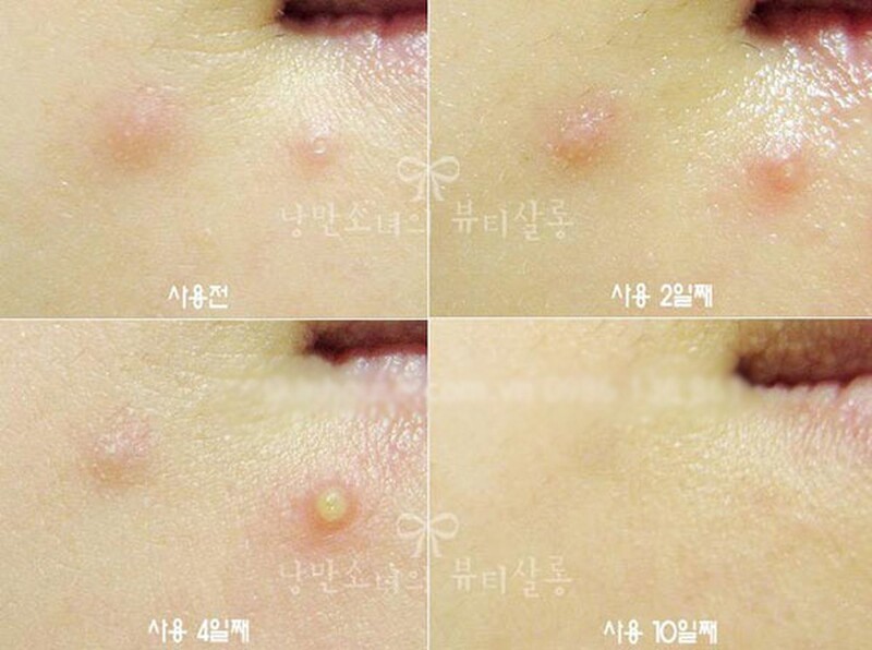 Kem Trị Mụn Innisfree Bija Trouble Spot Essence 15ml