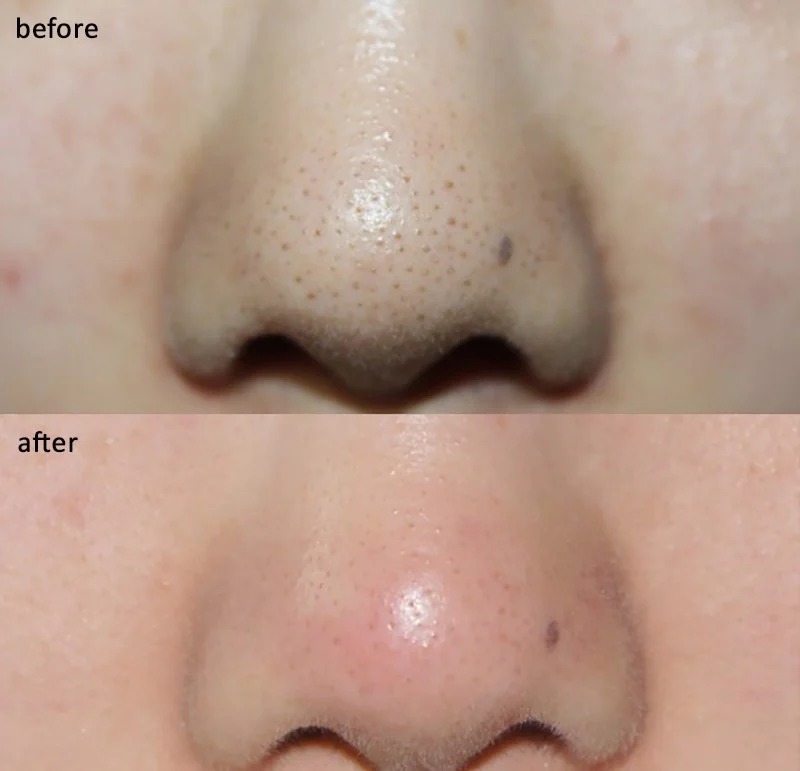 Miếng Đẩy Mụn Ciracle Goodbye Blackhead (1 Hộp)
