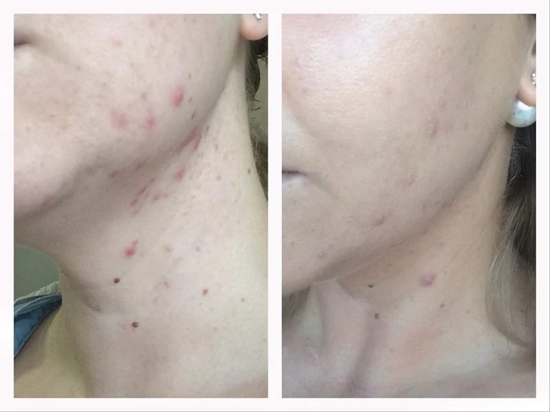 Kem Dưỡng Bioderma Sébium Global Cream Giảm Mụn, Ngăn Ngừa Mụn Tái Phát 30ml