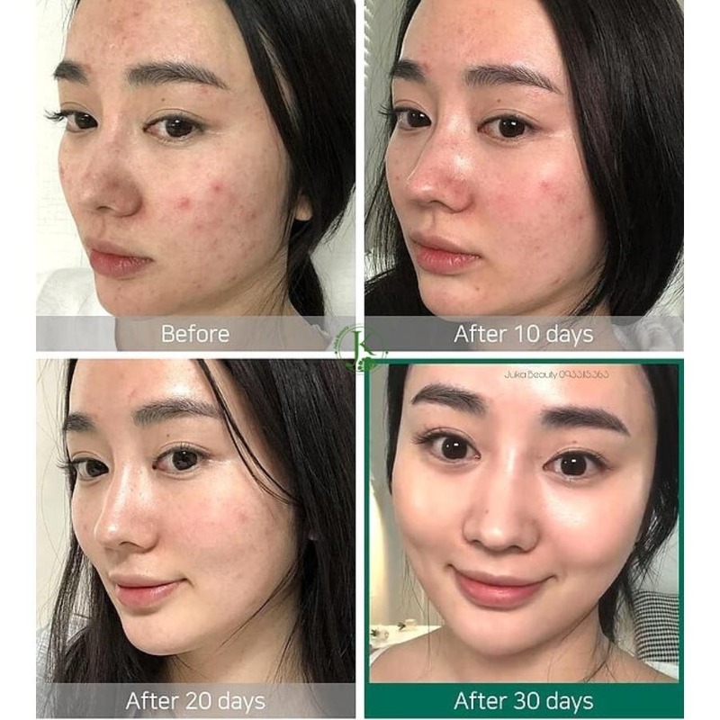 Nước Hoa Hồng Some By Mi AHA-BHA-PHA 30 Days Miracle Toner Cho Da Mụn 150ml