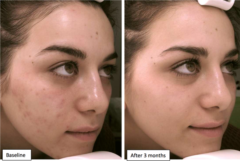 Kem Dưỡng OBAGI Tretinoin 0.05% Hỗ Trợ Giảm Mụn Giảm Lão Hóa 20g