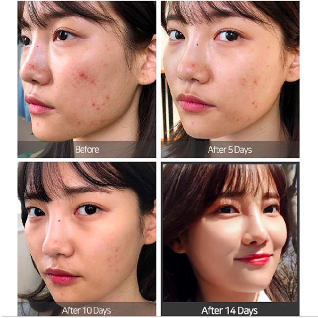Kem Chấm Mụn Some By Mi Super Miracle Giảm Mụn & Kháng Viêm 30ml