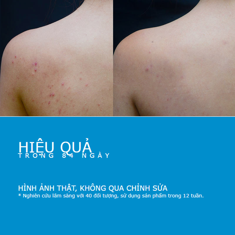 La Roche-Posay Kem Dưỡng Giảm Mụn + Gel Rửa Mặt & Tắm