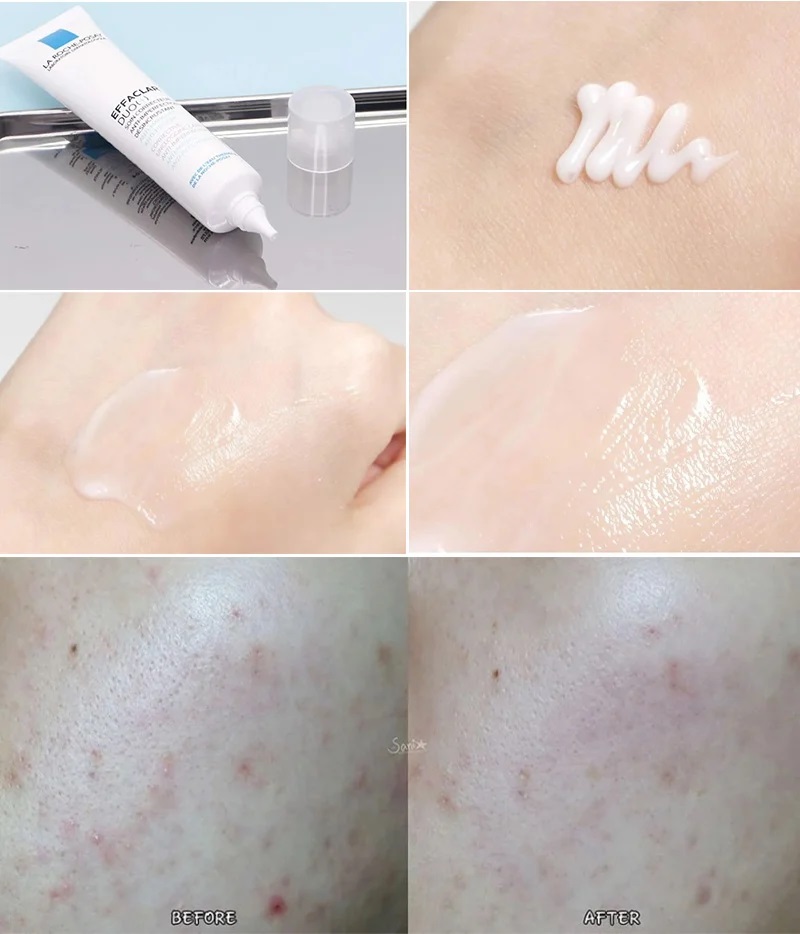 La Roche-Posay Kem Dưỡng Giảm Mụn + Gel Rửa Mặt & Tắm