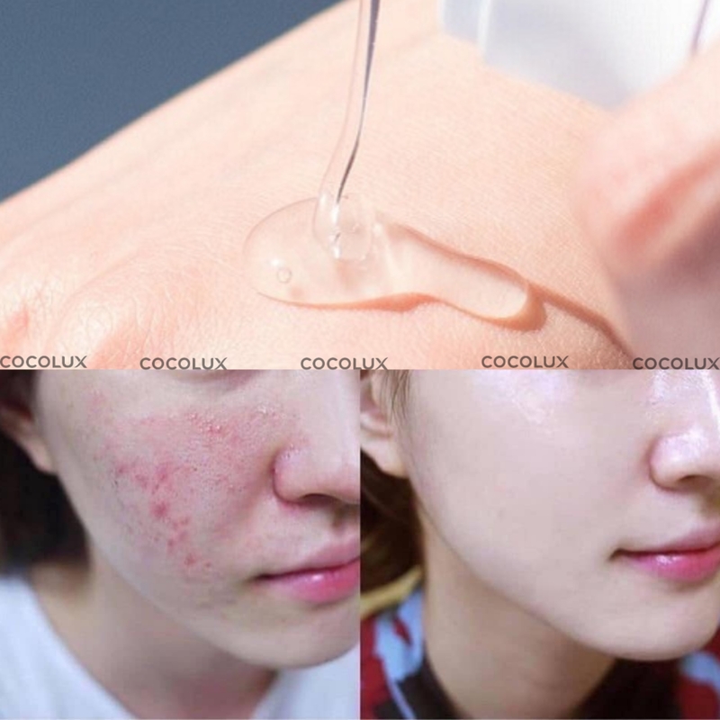 Gel Dưỡng Megaduo Giảm Mụn Và Vết Thâm 15g (Mẫu Mới)
