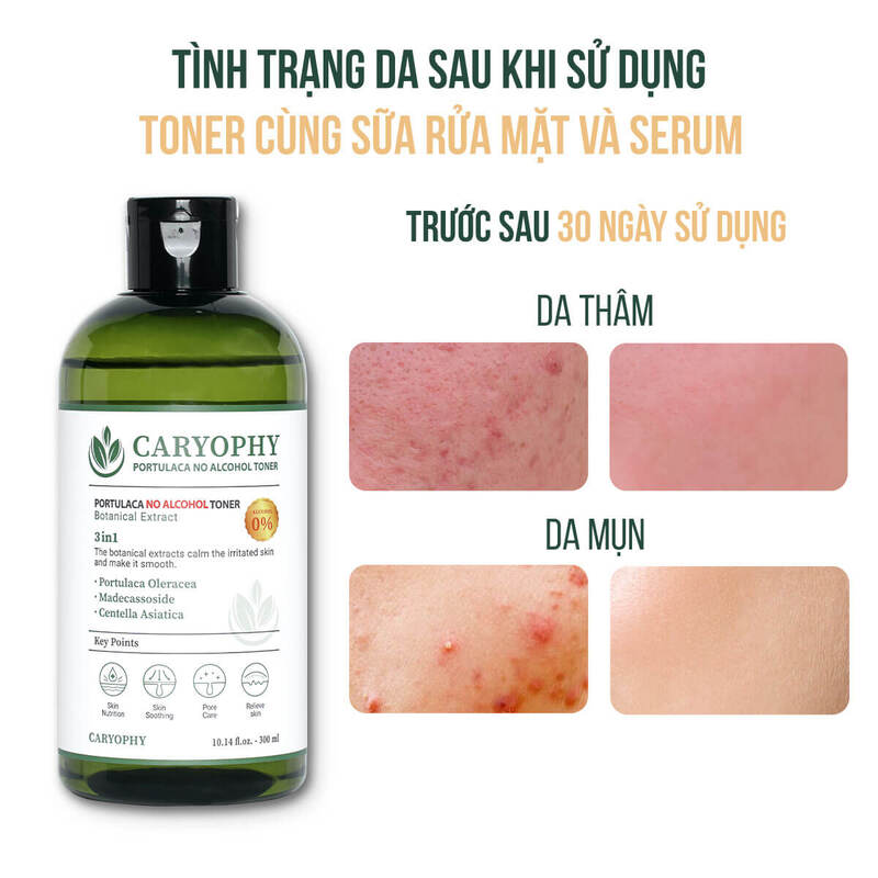 Nước Hoa Hồng Caryophy Cải Thiện Mụn Kiềm Dầu Giảm Thâm 300ml