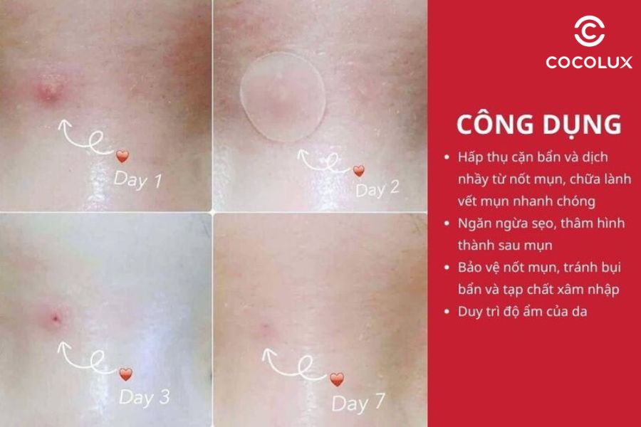 Công dụng của miếng dán mụn Cosrx Acnes Pimple Master Patch