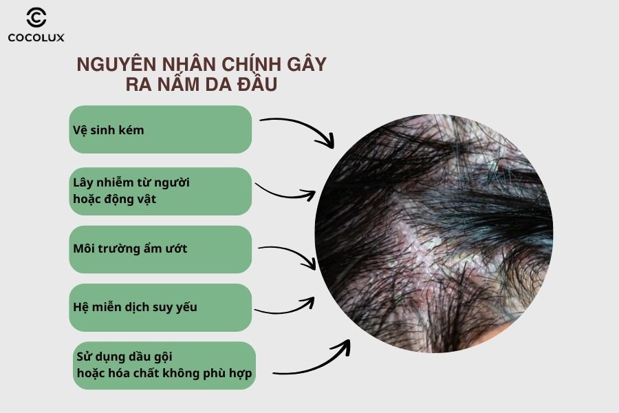 C&aacute;c nguy&ecirc;n nh&acirc;n ch&iacute;nh g&acirc;y ra nấm da đầu