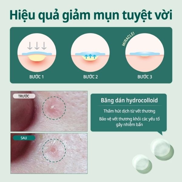 Miếng Dán Mụn Some By Mi Clear Spot Patch 18 PCS