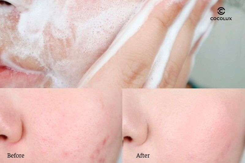 Sữa Rửa Mặt Byvibes Wonder Bath PHA 5.5 c&oacute; khả năng l&agrave;m giảm mụn