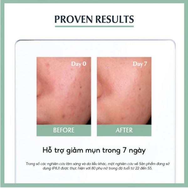 Tinh Chất Eucerin Dưỡng Cho Da Mụn Pro Acne SOS Serum 40ml