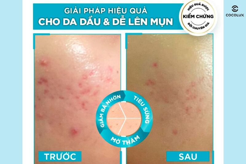 Tinh Chất Garnier Bright Complete Anti-Acne Booster Serum c&oacute; t&aacute;c dụng l&agrave;m giảm mụn hiệu quả