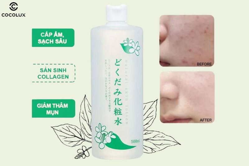 Trải nghiệm sử dụng nước hoa hồng Dokudami Natural Skin Lotion diếp cá ngăn ngừa mụn